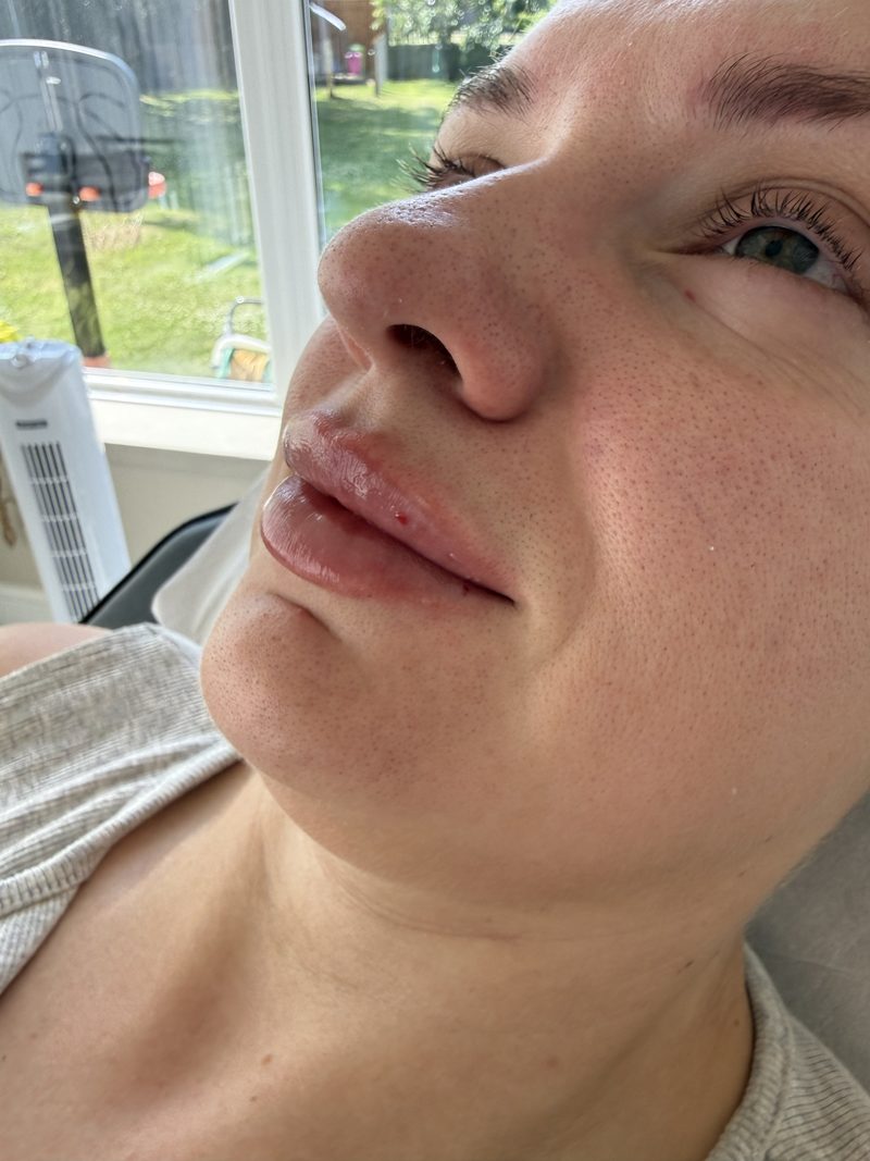 After: the same client's lips from the side
