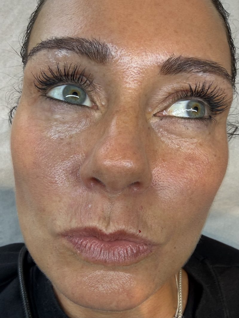 After: softer lines above the top lip