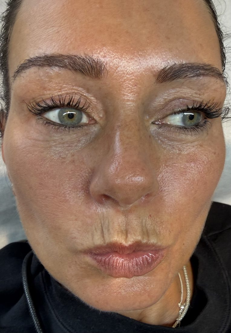 Before: lines above a client's top lip