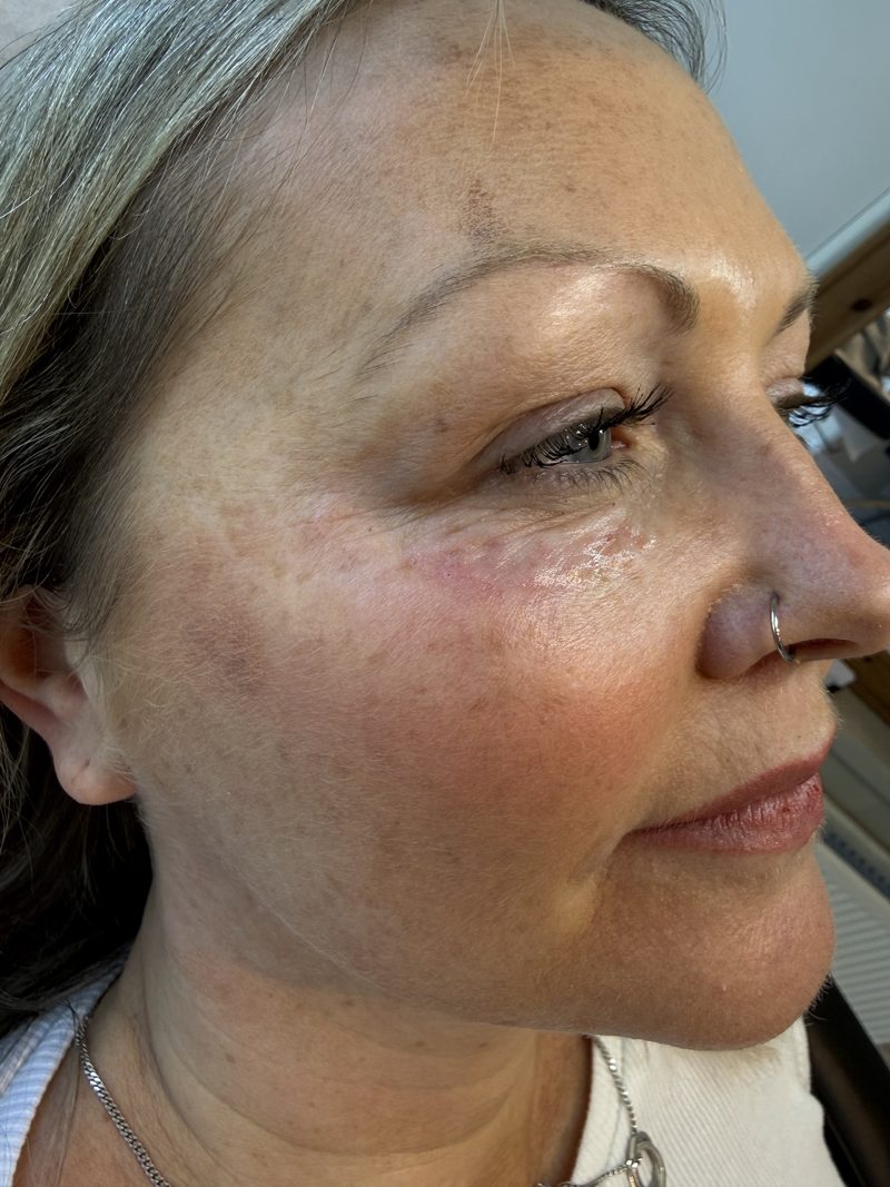 Straight after: the same view, with slight redness under the eye