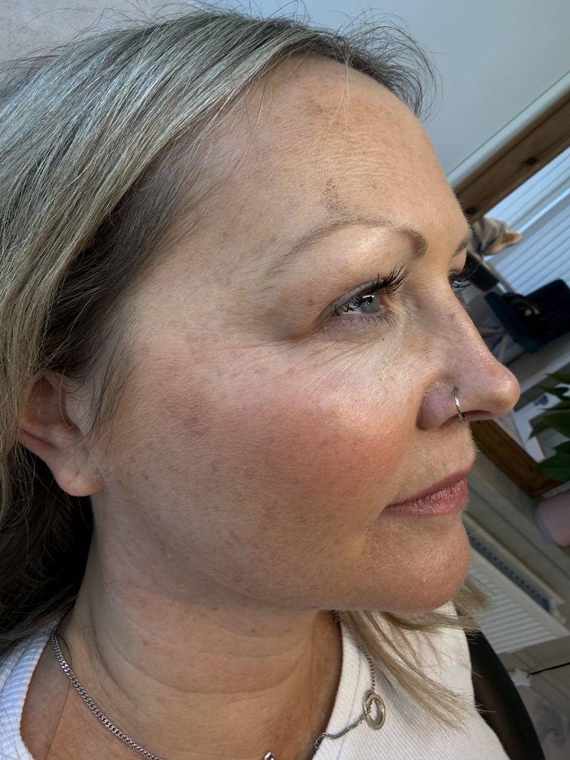 Before: side view of a client's cheek and under-eye area